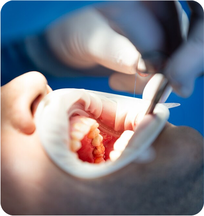 Root Canals