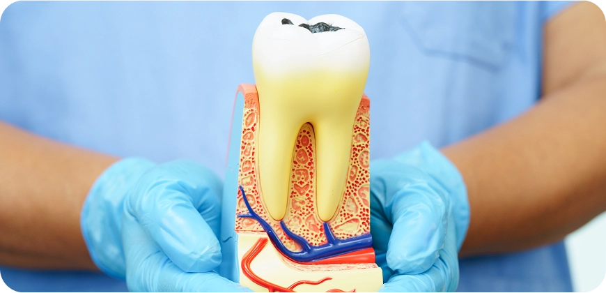 Root Canal treatment